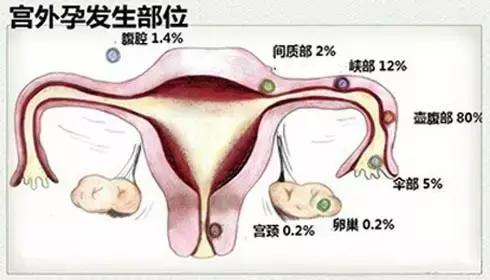 无瘢痕手术：单孔腹腔镜，让爱美女性不再为“疤”苦恼