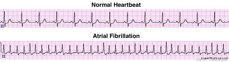 房颤患者属于慢性病吗,房颤究竟是怎么得的