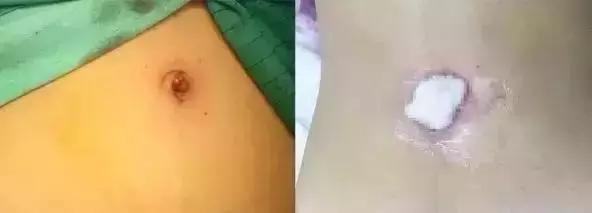 无瘢痕手术：单孔腹腔镜，让爱美女性不再为“疤”苦恼