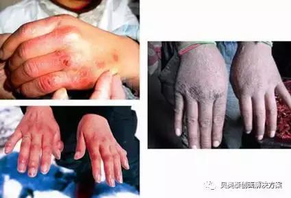 冻伤的分级和治疗,冻伤的预防与处置