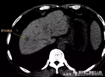 治癌手术,肿瘤消融术能治什么癌症