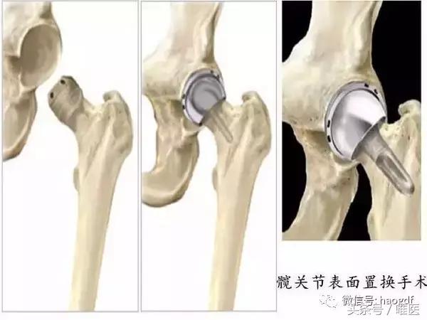 髋关节置换术后引流管的护理,髋关节置换围手术期护理ppt