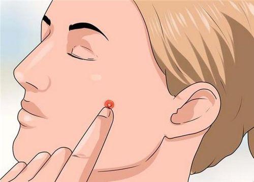 如何彻底告别痘痘成人痘,有一种痘很大个是红色的