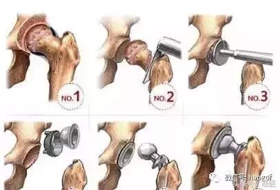 髋关节置换术后引流管的护理,髋关节置换围手术期护理ppt