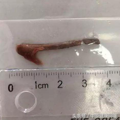 男子咳嗽两年未好转检查结果吓人,35岁男人咳嗽3个月一直不好