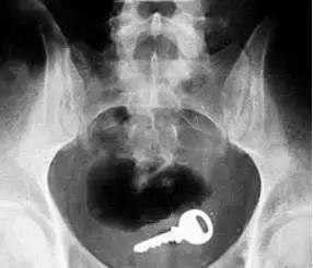 儿童身上肿胀流脓怎么回事,6岁儿童反复化脓