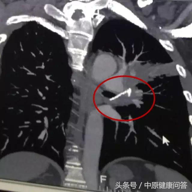 男子咳嗽两年未好转检查结果吓人,35岁男人咳嗽3个月一直不好