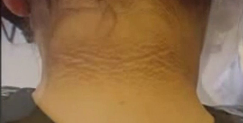 脖子后面有黑色纹路怎么回事,脖子上的纹路像脏的一样怎么回事