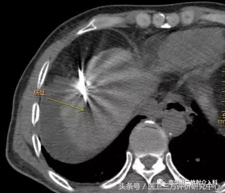 治癌手术,肿瘤消融术能治什么癌症