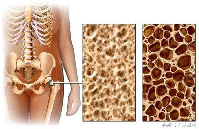 肾性骨病都有哪些症状,肾性骨病一定会有肾脏病表现吗