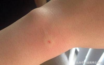 蜂针治疗后为什么痒,蜂刺红肿怎么处理