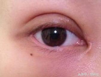 医美祛疤方法,医美祛色素疤痕