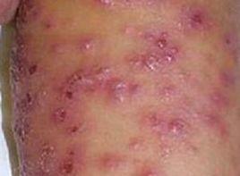 湿疹最怕的三种野菜,防秋燥的中药有哪些