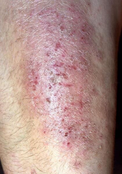 湿疹最怕的三种野菜,防秋燥的中药有哪些