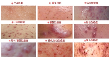 青春痘治疗的8大误区,青春痘治疗的恢复过程