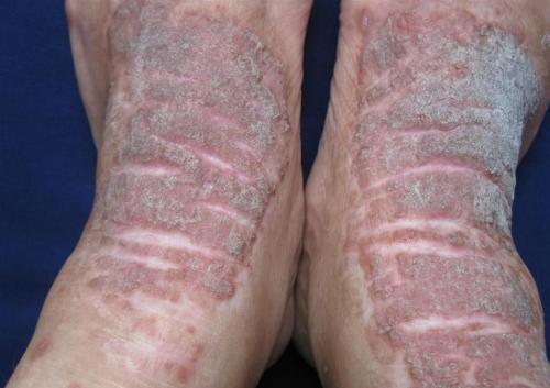 湿疹最怕的三种野菜,防秋燥的中药有哪些