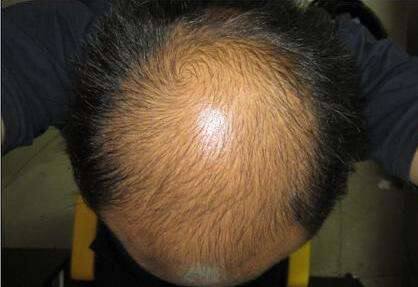 经常熬夜脱发用什么洗发水好,熬夜脱发吃什么药可以治一下