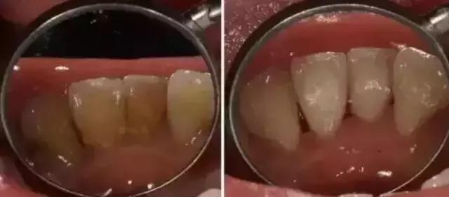 经常梦到牙齿松动脱落怎么回事,牙齿松动咬不动硬的菜怎么回事