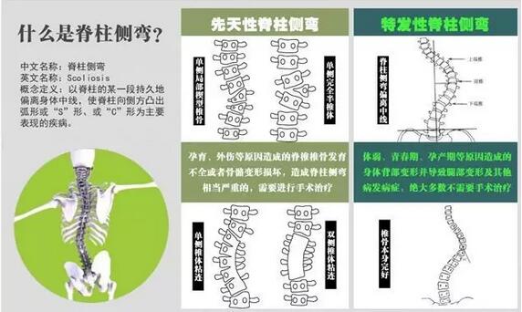 案例l3D打印支具助力青少年脊柱侧弯保守治疗