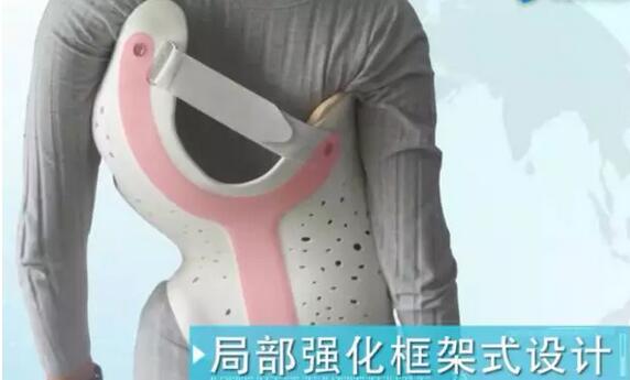 案例l3D打印支具助力青少年脊柱侧弯保守治疗