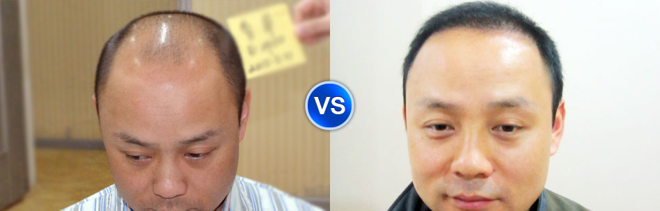 头发一掉一大把怎么改善,女性头发很油脱发很严重怎么解决