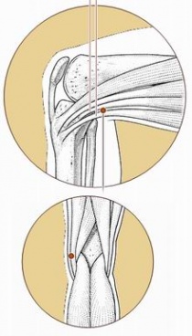 胃脘痛传统针灸秘术,胃脘痛董氏针灸