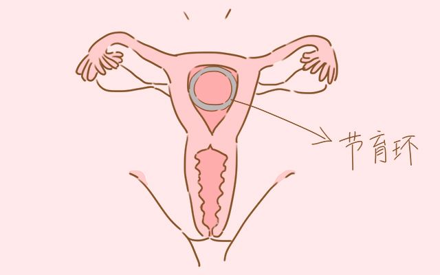 取环时疼吗取环后要关注什么,取环疼不疼啊