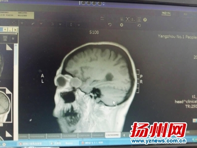 双眼肿胀3个月视力降至0.3原是眼眶里长了颗肿瘤