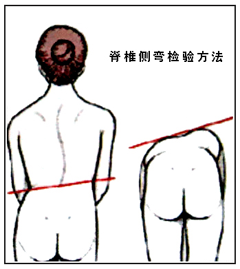 正常范围内的脊柱侧弯图片,脊柱侧弯的凸侧和凹侧