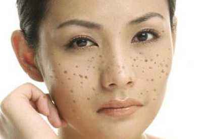 脸上一个斑皮下一窝斑是真的吗,脸上的斑时而淡时而显是什么斑