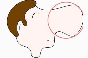一个鼻窦长了囊肿是什么症状,做什么检查可以发现鼻部的囊肿
