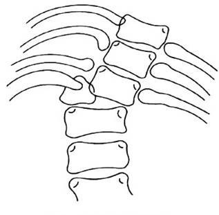 正常范围内的脊柱侧弯图片,脊柱侧弯的凸侧和凹侧