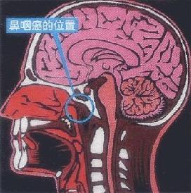 鼻咽癌放疗后牙齿酸怎么办,鼻咽癌放疗对牙齿影响