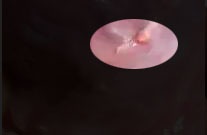 女性尖锐湿疣症状,尖锐性湿疣长嘴里会怎么样