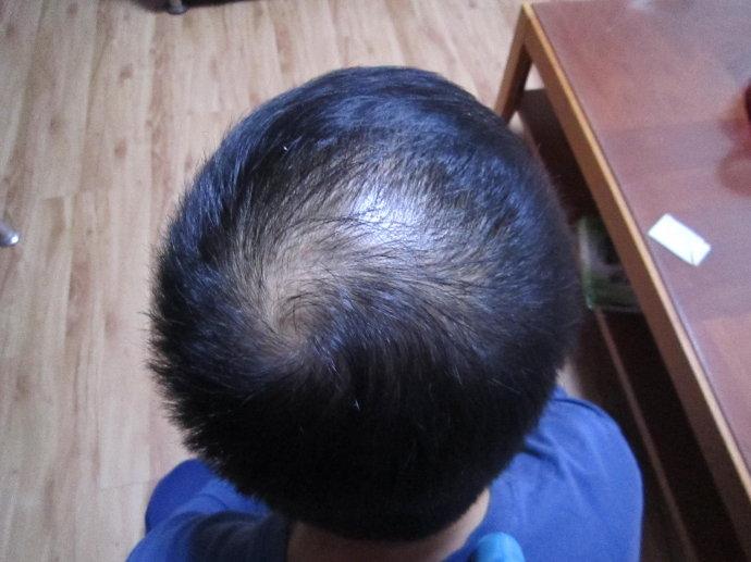 40岁男脱发秃顶多年了怎么治,男士脱发秃顶怎么办