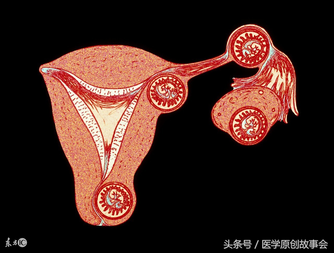 17岁少女腹痛难忍，清晨突发意外，医生全力抢救仍未能挽回！