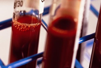 等有了尿毒症的前兆后要怎么办,一旦引起尿毒症还能逆转吗