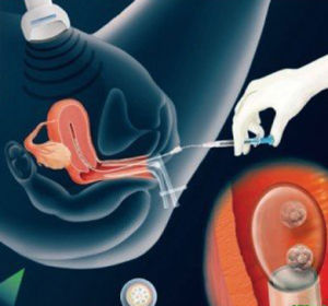 做试管婴儿的女性到底有多遭罪,女人做试管婴儿究竟有多痛苦