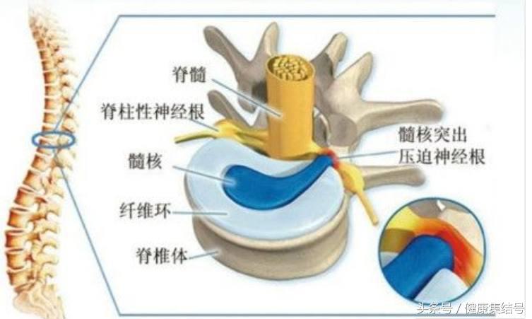腰痛为什么会引起腿痛怎么治疗,腰痛为何很难治愈