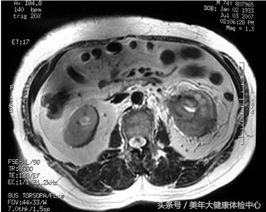 如何判定自己得的是肾集合管癌,恶性肾细胞癌