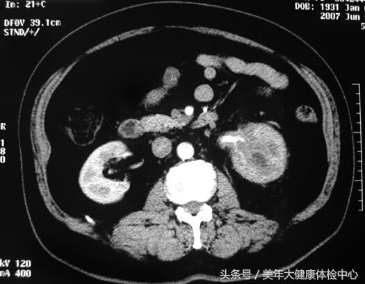 如何判定自己得的是肾集合管癌,恶性肾细胞癌