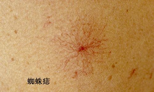 慢性肝病红点,肝病引起的小红痣如何去除
