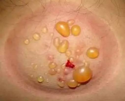 拔罐都是水泡怎么回事,身上湿气重拔罐有水泡