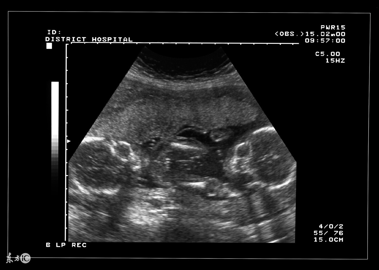 双胞胎孕妇如何选择分娩方式？