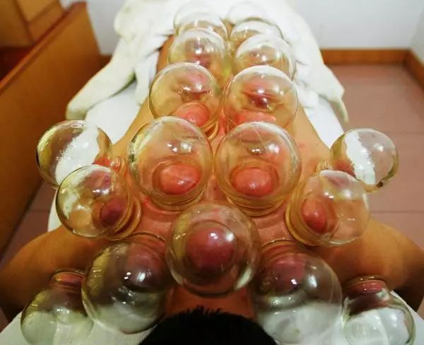 拔罐都是水泡怎么回事,身上湿气重拔罐有水泡