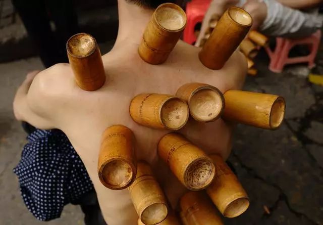 拔罐都是水泡怎么回事,身上湿气重拔罐有水泡