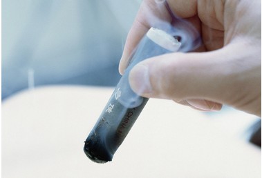 艾灸后瘀血从哪里排,艾灸腰腺肌症排出大量淤血块