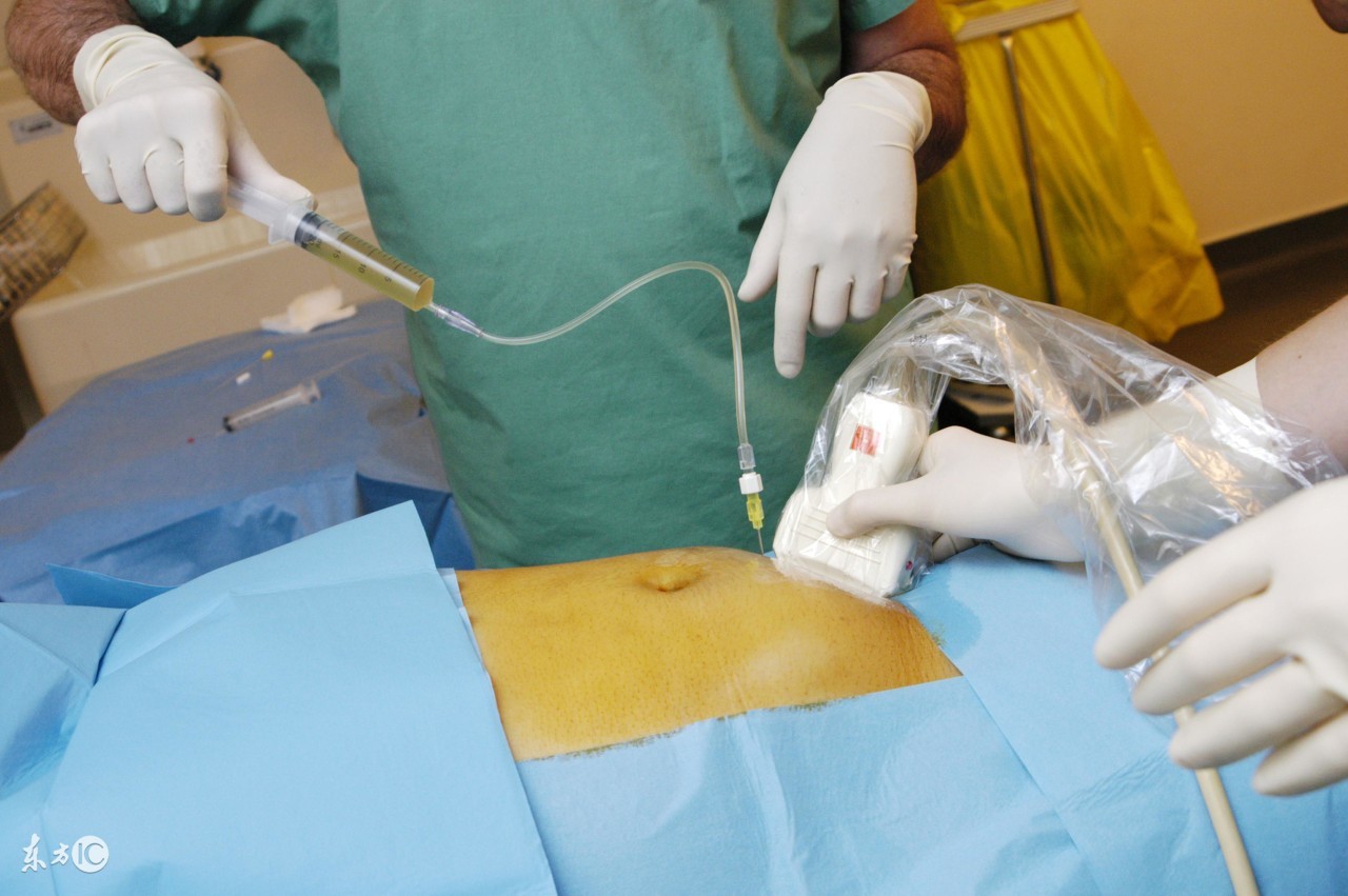 羊水穿刺怎么做的过程,南宁医科大羊水穿刺过程