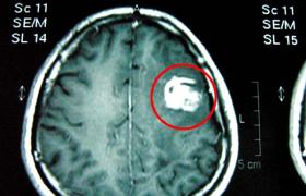 男子脑中寄生虫,10岁男孩脑袋里有寄生虫