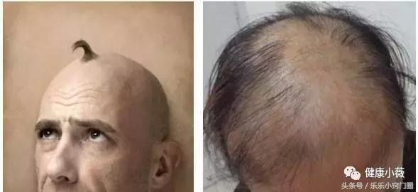 防脱发的食疗小方法,两个食疗方有效改善中年脱发